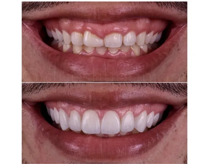 Smile before and after treatment by Dr. Fox