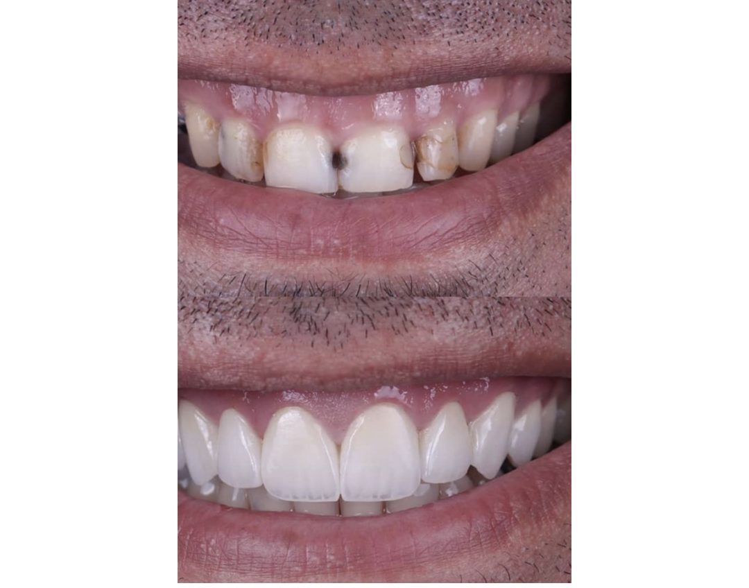 Veneer case before and after