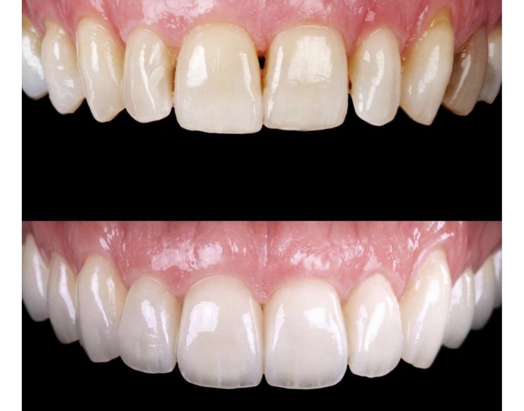 Veneer case before and after