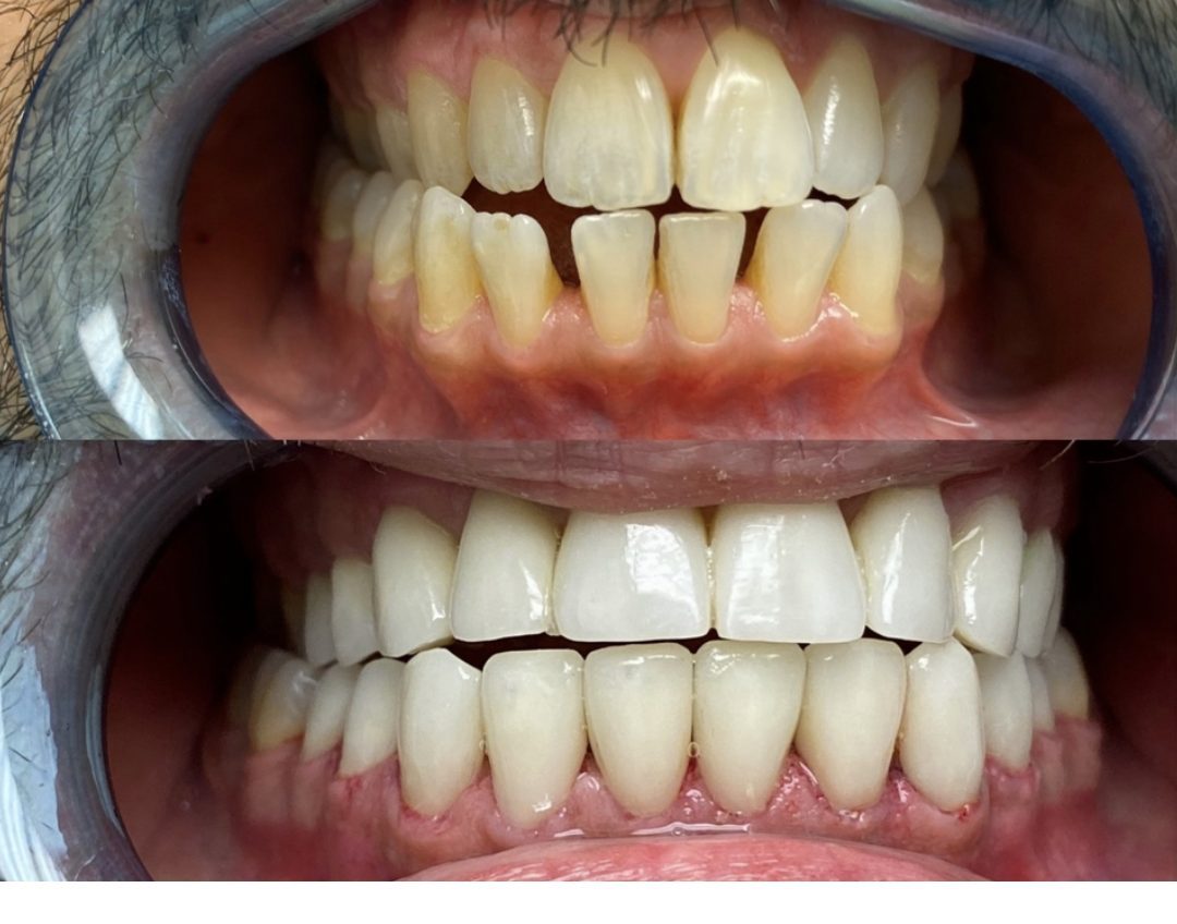 Veneer case before and after