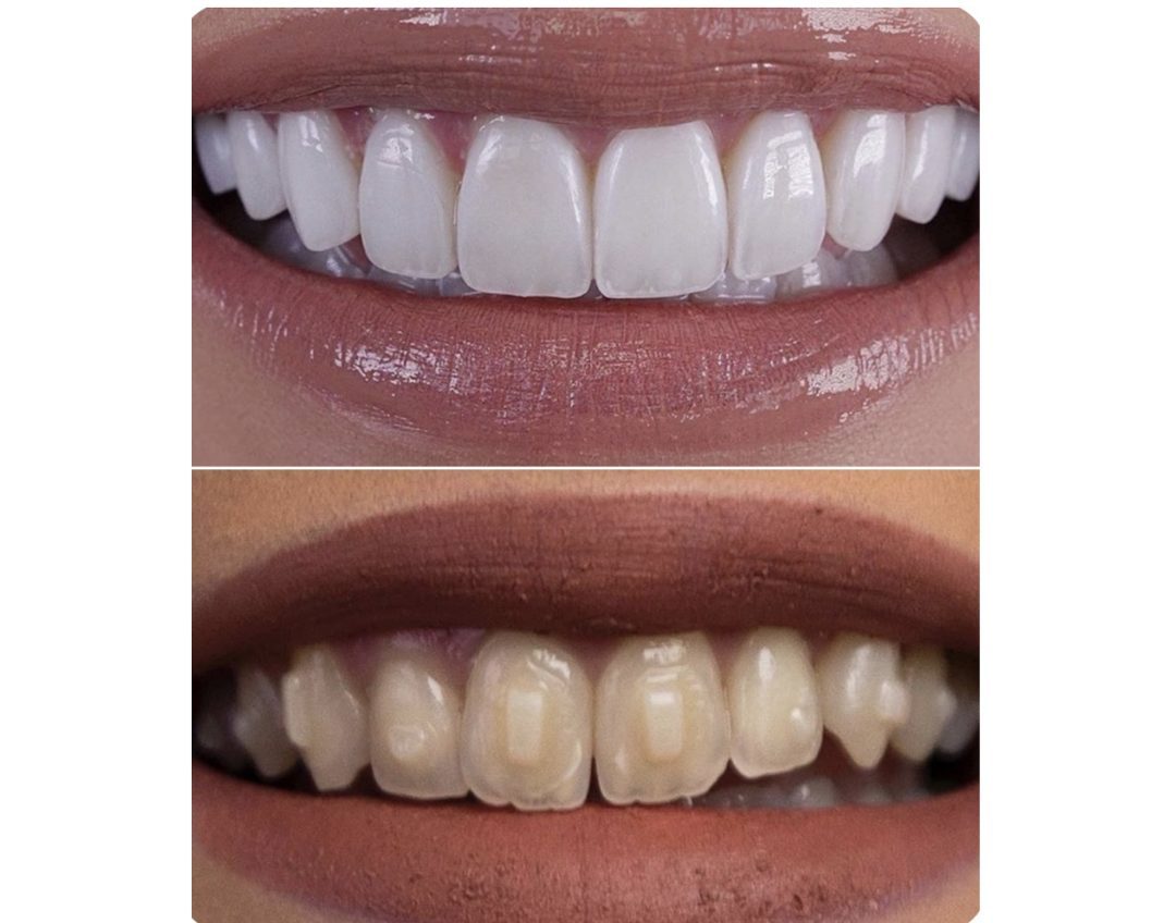 Veneer case before and after