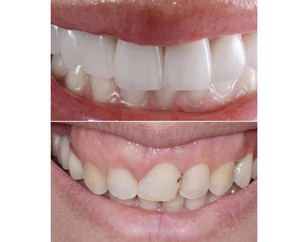Veneer case before and after