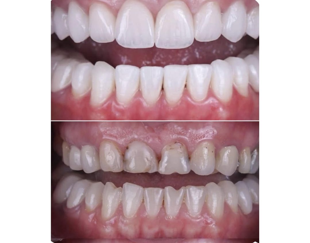 Veneer case before and after