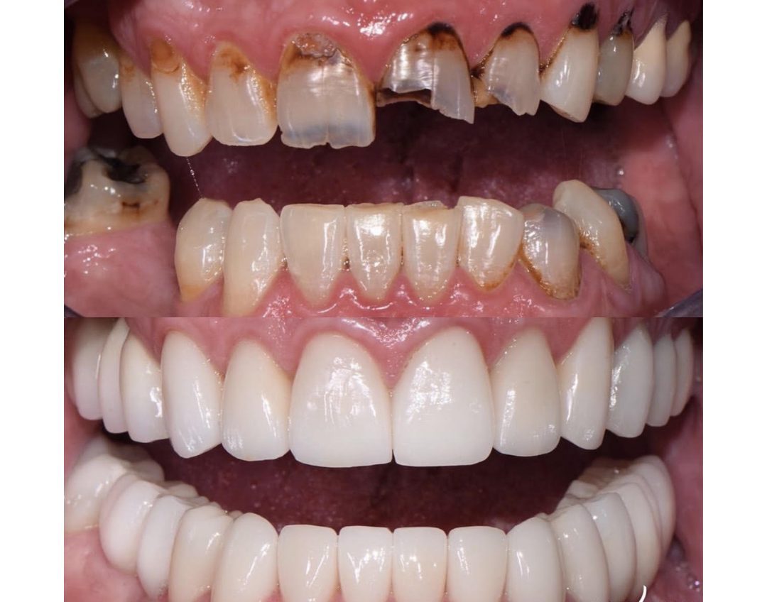 Veneer case before and after