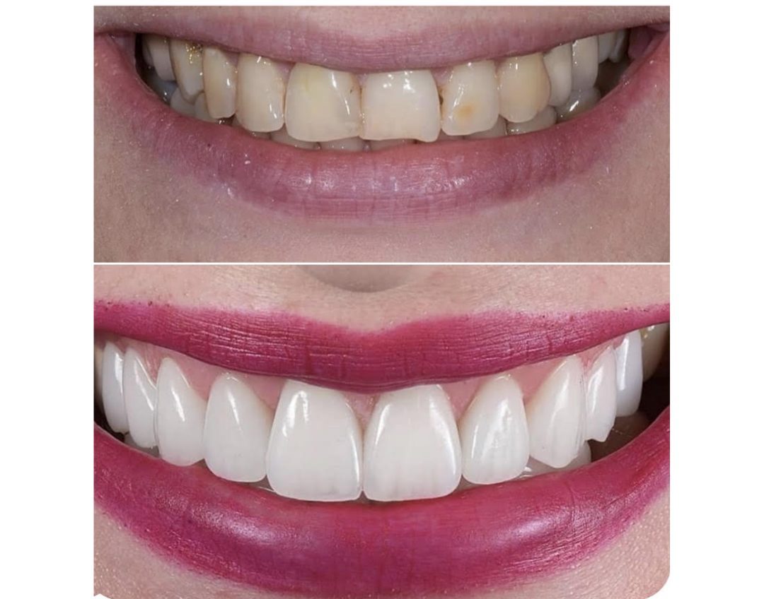 Veneer case before and after