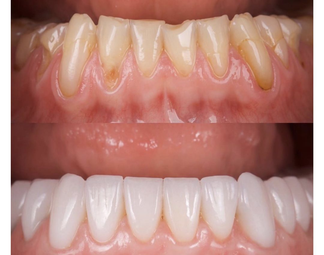 Veneer case before and after