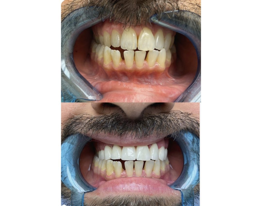 Veneer case before and after